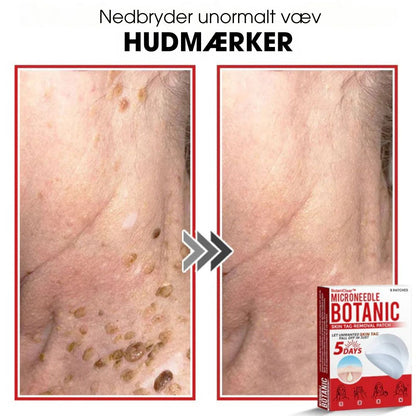 BotaniClear™ – Microneedle-patch til hudflapper - 1+1 GRATIS