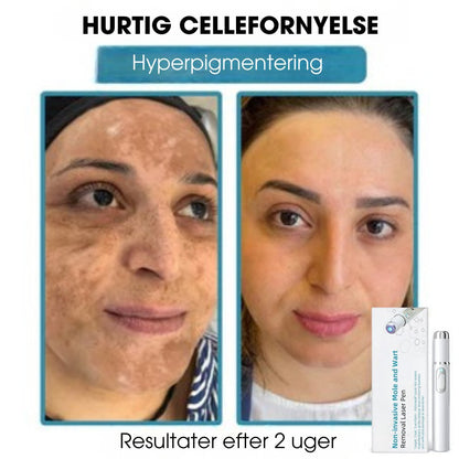 DermaLight Pro™ - Ikke-invasiv laserpen til modermærker, vorter og hudflapper