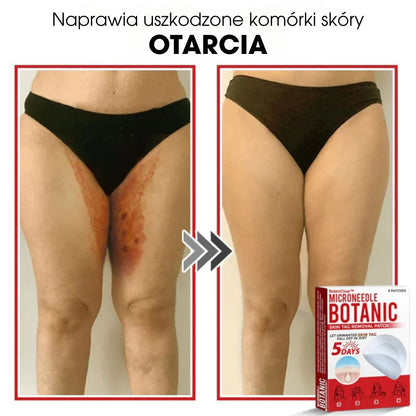 BotaniClear™ – Microneedle-patch til hudflapper - 1+1 GRATIS