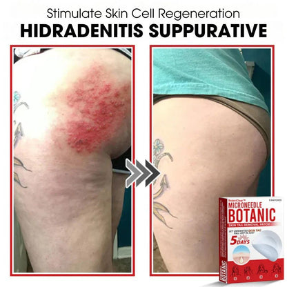 BotaniClear™ – Microneedle-patch til hudflapper - 1+1 GRATIS