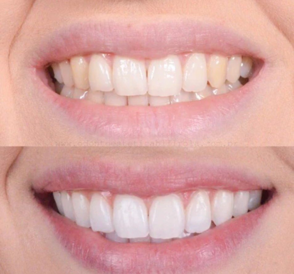 BrightSmile™ – Klinik-inspireret tandblegning til hjemmebrug