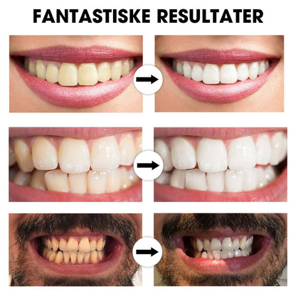 BrightSmile™ – Klinik-inspireret tandblegning til hjemmebrug