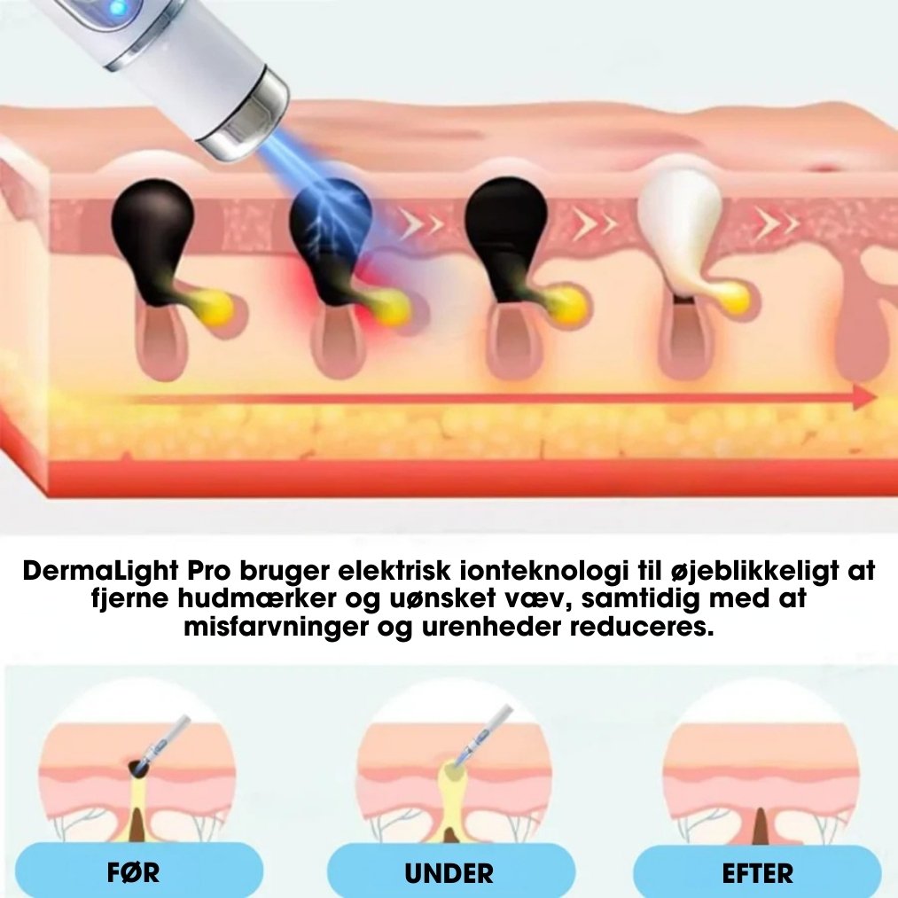 DermaLight Pro™ - Ikke-invasiv laserpen til modermærker, vorter og hudflapper