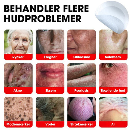 BotaniClear™ – Microneedle-patch til hudflapper - 1+1 GRATIS