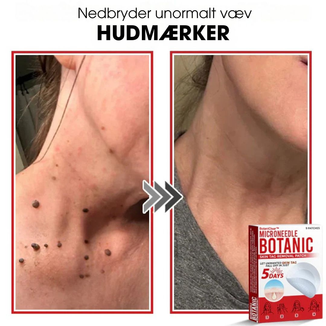 BotaniClear™ – Microneedle-patch til hudflapper - 1+1 GRATIS