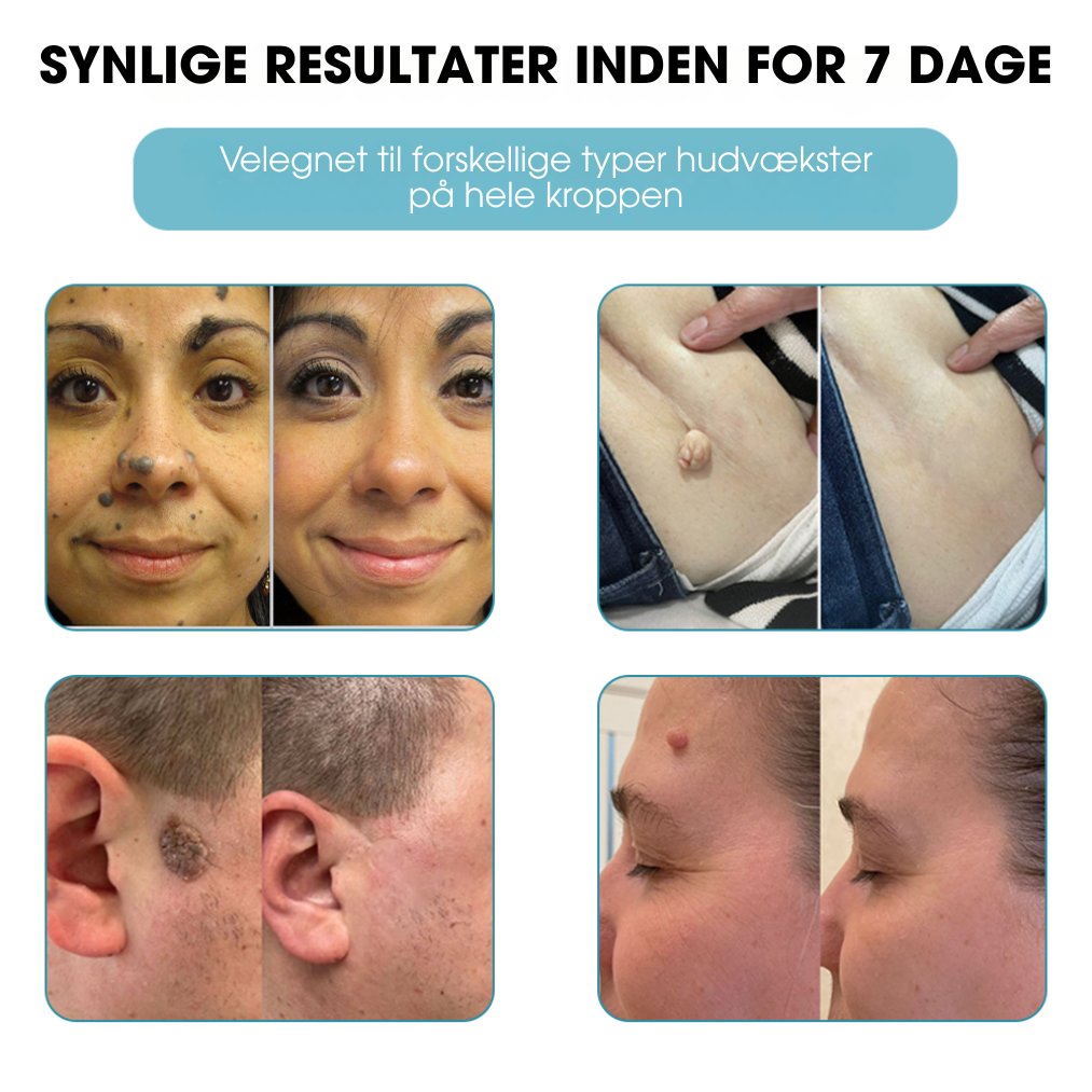 DermaLight Pro™ - Ikke-invasiv laserpen til modermærker, vorter og hudflapper